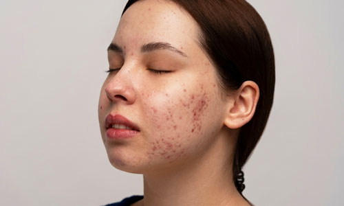 Acne Scars Treatment