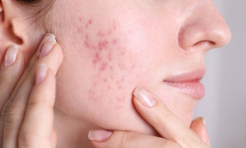 Acne Treatment