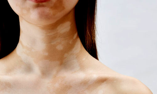 Pigmentation Treatment